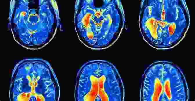 Brain Scan Revealing Neurological Activity Understanding Psychopathy: The Biopsychosocial Perspective (New Frontiers In Forensic Psychology)