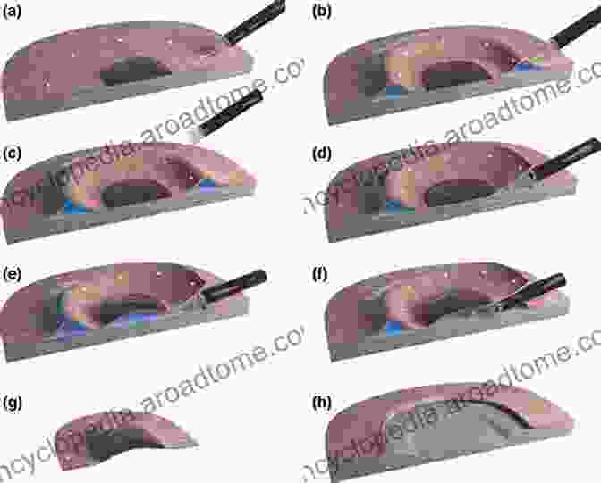 Endoscopic Submucosal Dissection (ESD) Recent Advances In Gastroenterology: Proceedings Of Digestive Disease Week Japan (DDW Japan 98) April 15 18 1998 Yokohama