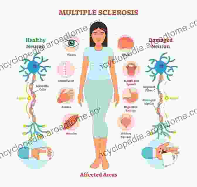 Illustration Of Lifestyle Changes For MS Prevention And Management Clues To The Cause Questions For A Cure: The Poisons Causing Multiple Sclerosis Worldwide