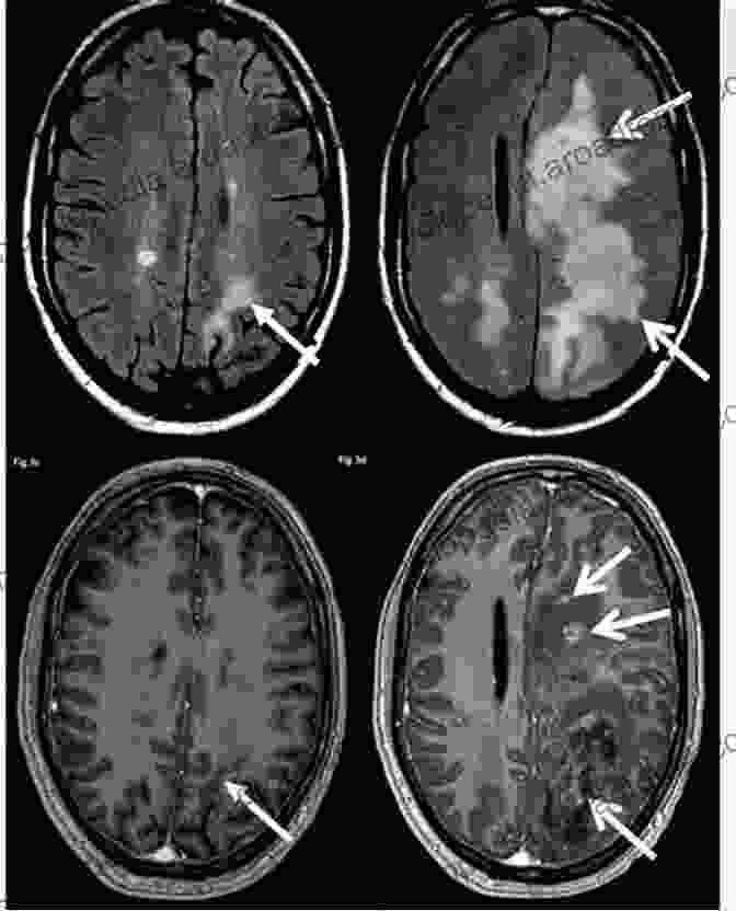 Magnetic Resonance Imaging (MRI) Scan Of A Brain With Multiple Sclerosis Lesions Uncomfortably Numb: A Memoir About The Life Altering Diagnosis Of Multiple Sclerosis