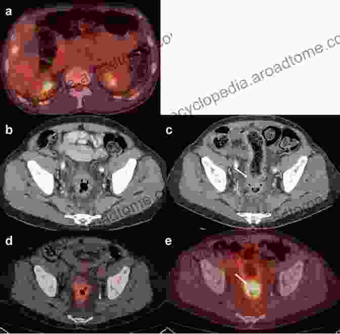 PET/CT Scan Of A Patient With Colorectal Cancer, Highlighting The Tumor In Red PET/CT In Colorectal Cancer (Clinicians Guides To Radionuclide Hybrid Imaging)