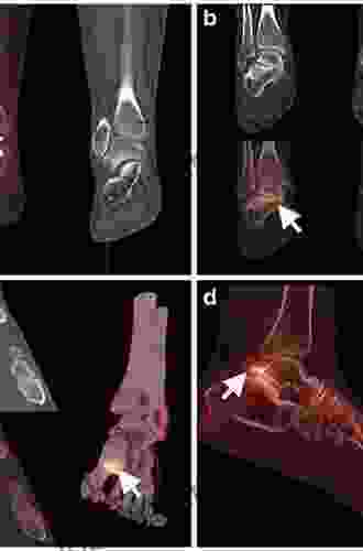 Bone SPECT/CT Of Ankle And Foot