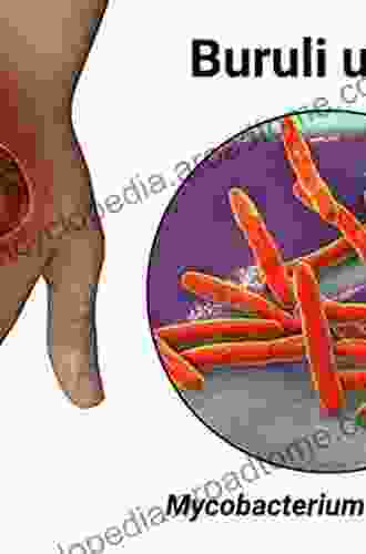 Buruli Ulcer: Mycobacterium Ulcerans Disease