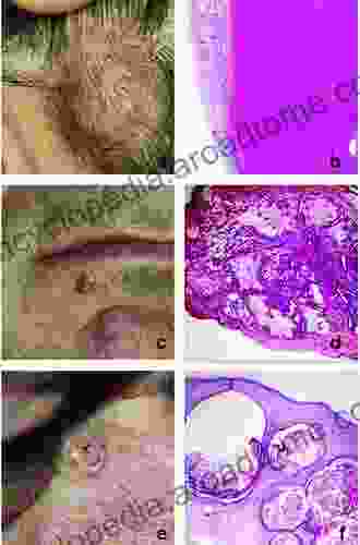 Cutaneous Adnexal Neoplasms